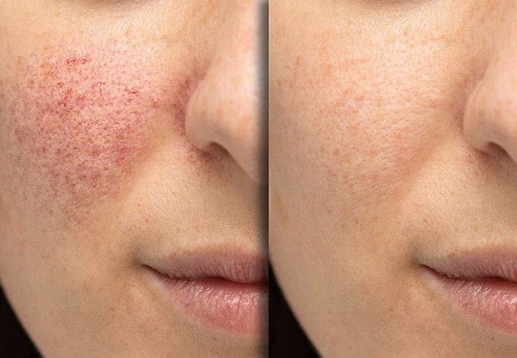 IPL Light Skin Therapy